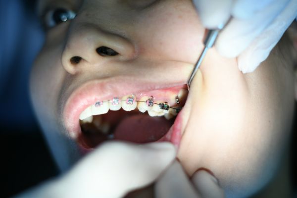 Top 5 raisons de choisir un orthodontiste à Nanterre